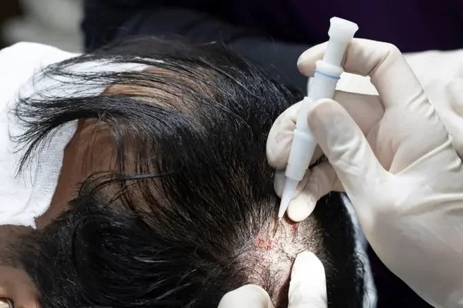 "Experience the Future of Hair Restoration: PRP Treatments in Dubai"