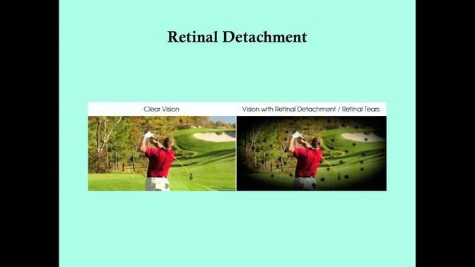 Retinal Detachment - CRASH! Medical Review Series