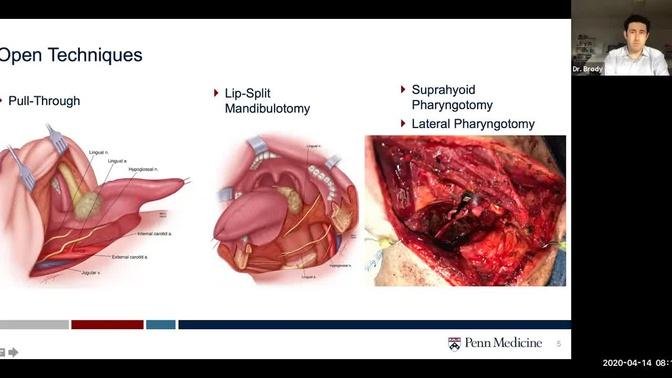 Surgical Treatment of Oropharyngeal Cancer - Dr. Robert Brody