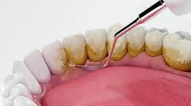 Transforming Smiles: The Impact of Teeth Polishing & Scaling in Dubai