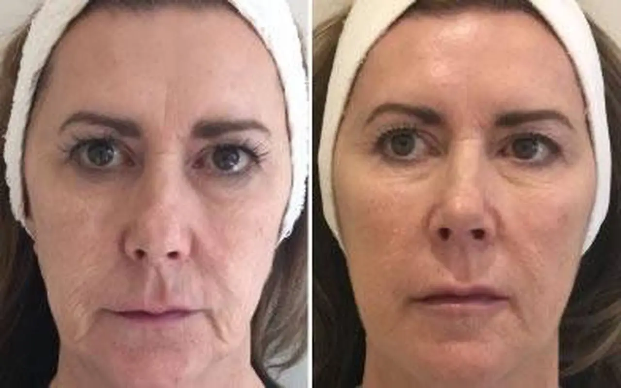 Revolutionizing Skin Rejuvenation Profhilo in Leeds