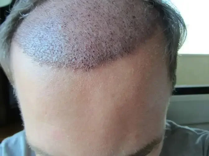 Who is a Good Candidate for a Hair Transplant?