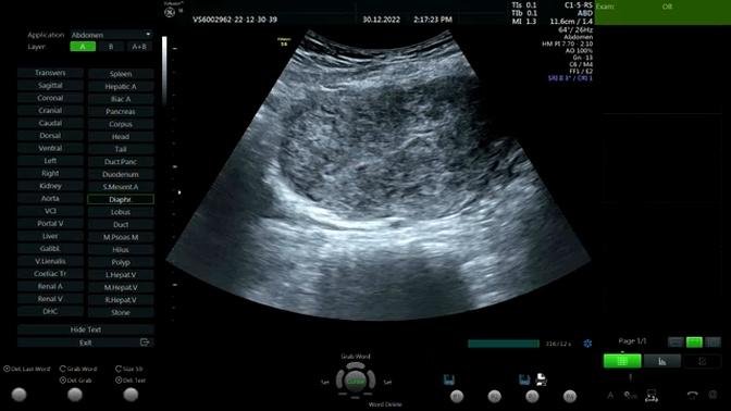 Ultrasound: Uterine: Adenomyosis