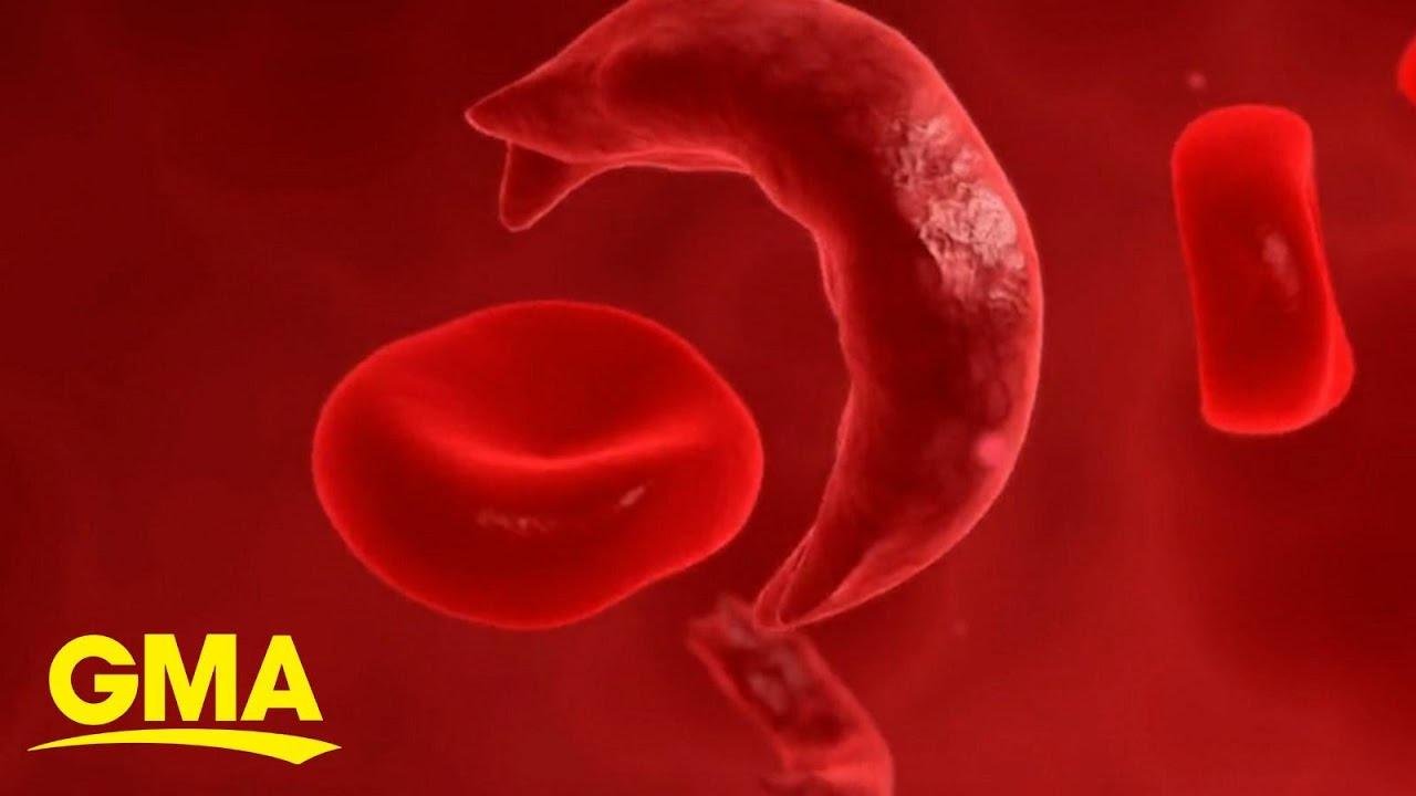 FDA approves 2 breakthrough treatments for those living with sickle cell disease
